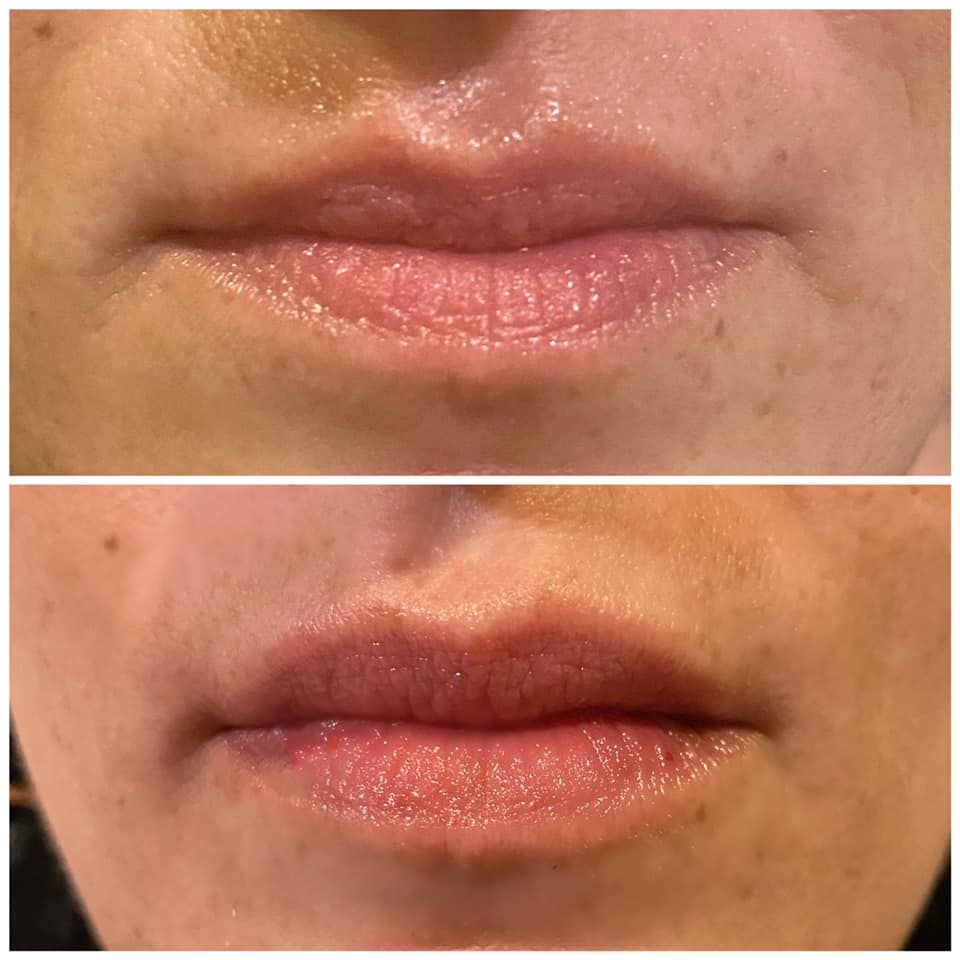 Close-up of lips before and after treatment, showing reduced redness and swelling.