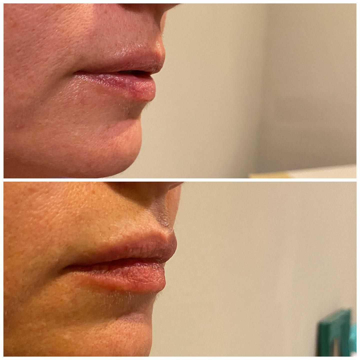 Side-by-side close-up of lips before and after, showing drier skin and a slight lip change