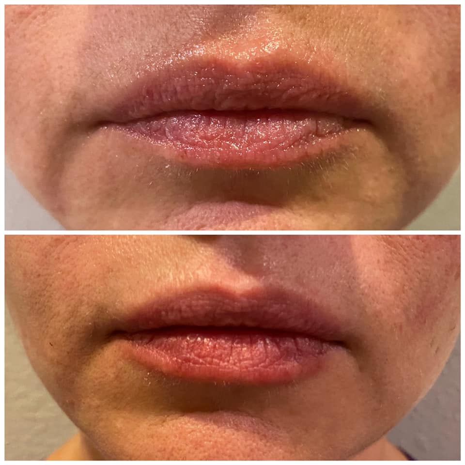 Close-up of lips before and after treatment, with fuller, pinker lower lip in the second image