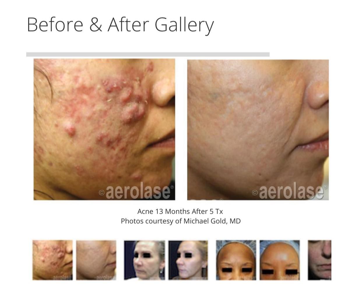 Before-and-after facial skin treatment results, showing acne lesions reduced on a cheek.