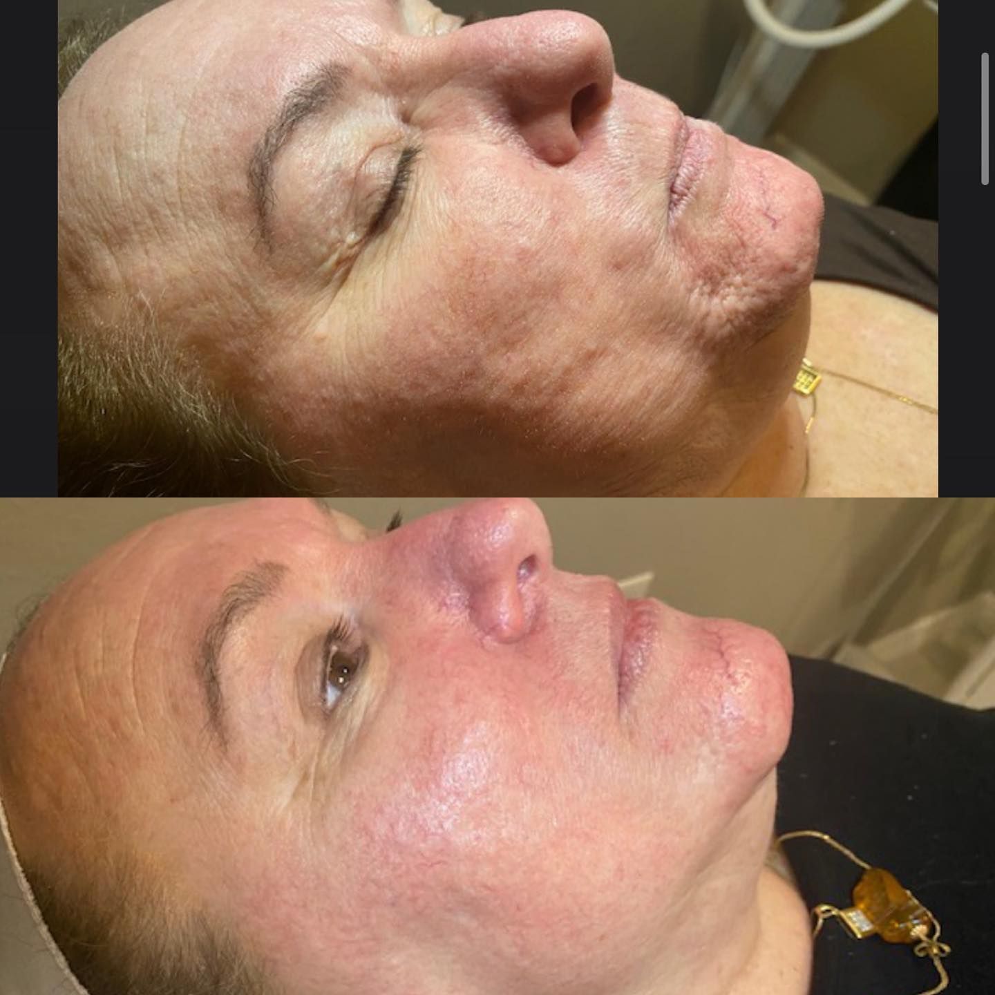 Two side-by-side close-ups of a woman's face before and after treatment, showing smoother skin and reduced wrinkles