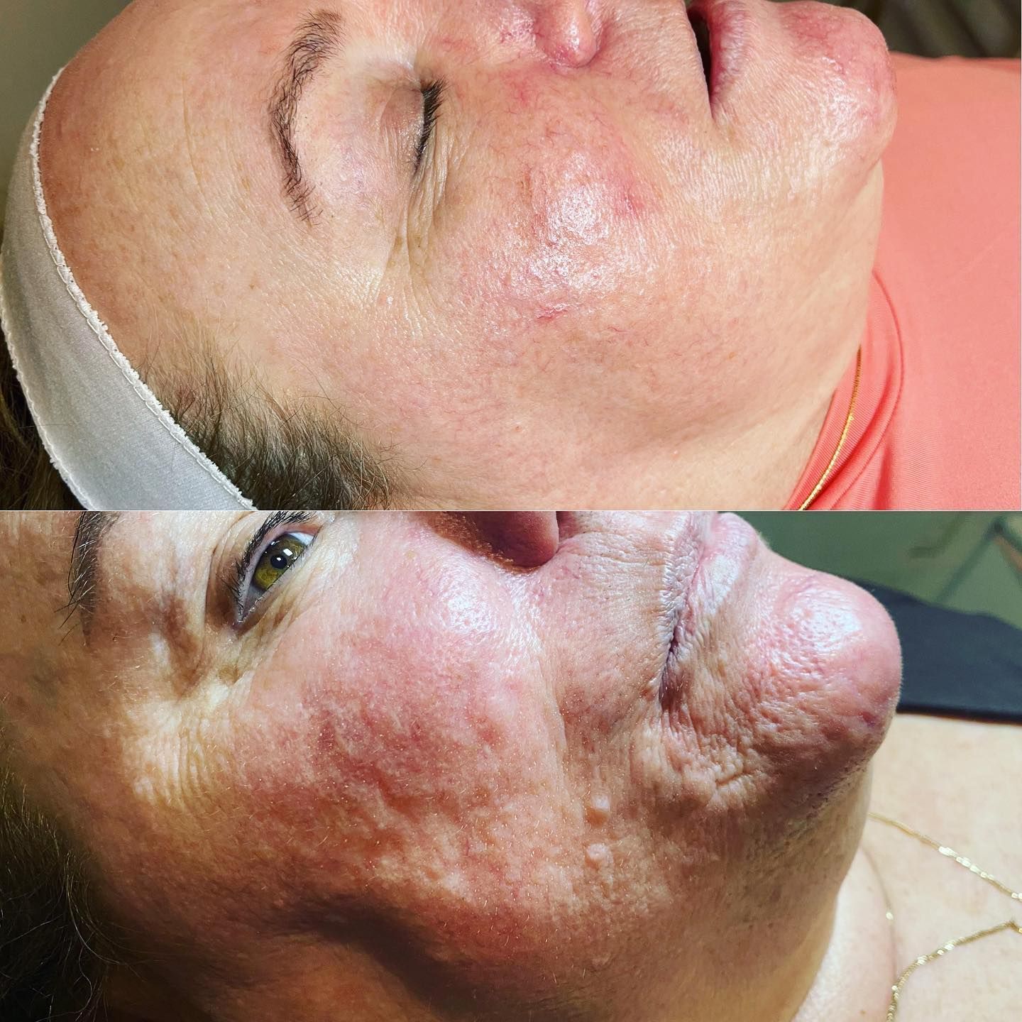 Close-up of a face with a large red swollen rash on the cheek and jawline, shown in two views.
