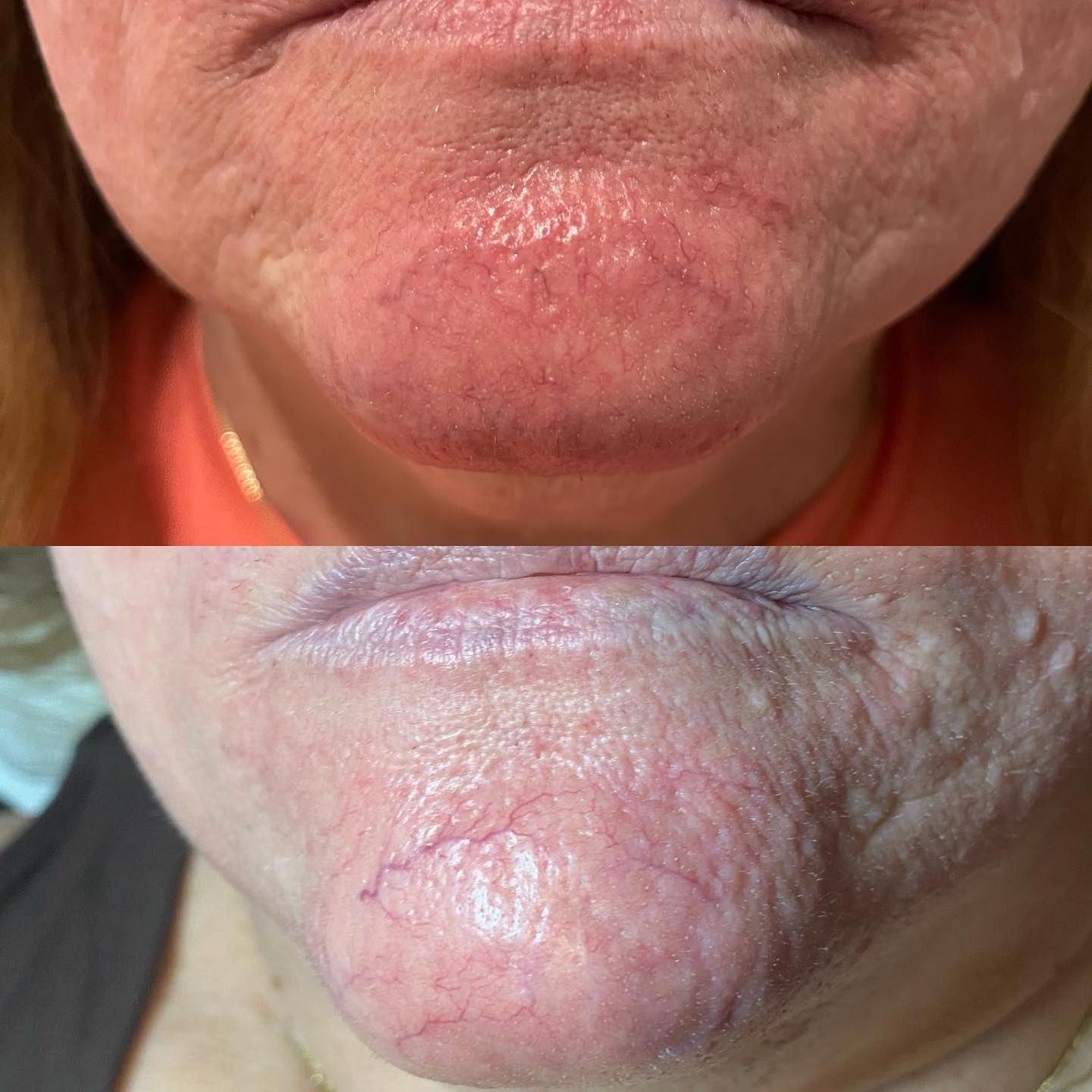 Close-up comparison of a chin and lower lip with pink, irritated skin and fine lines.