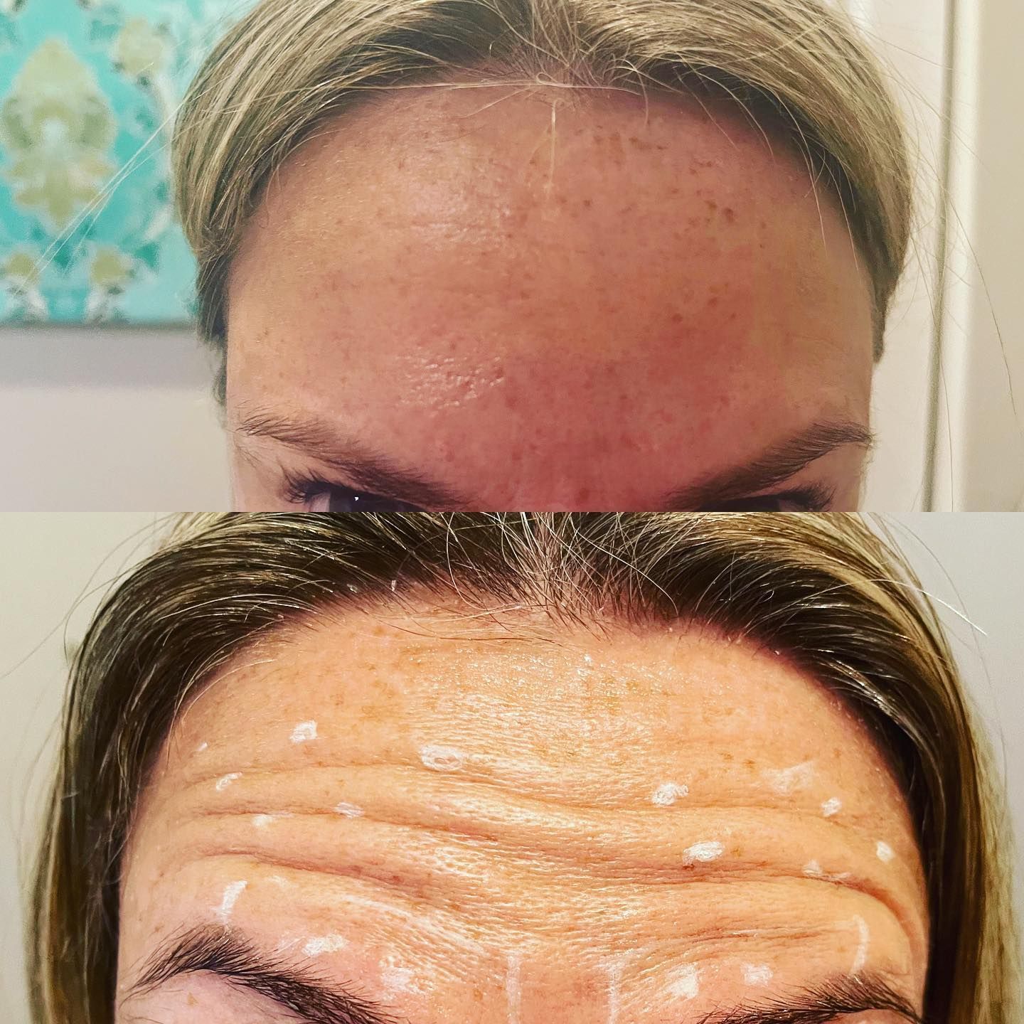 Close-up of a forehead with white facial cream, mirrored above against a patterned wall