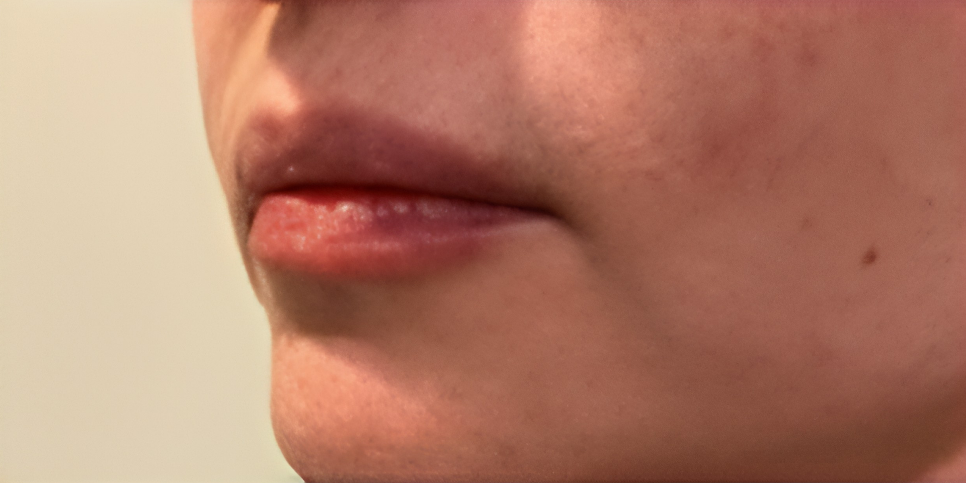 After IPL Skin Rejuvenation