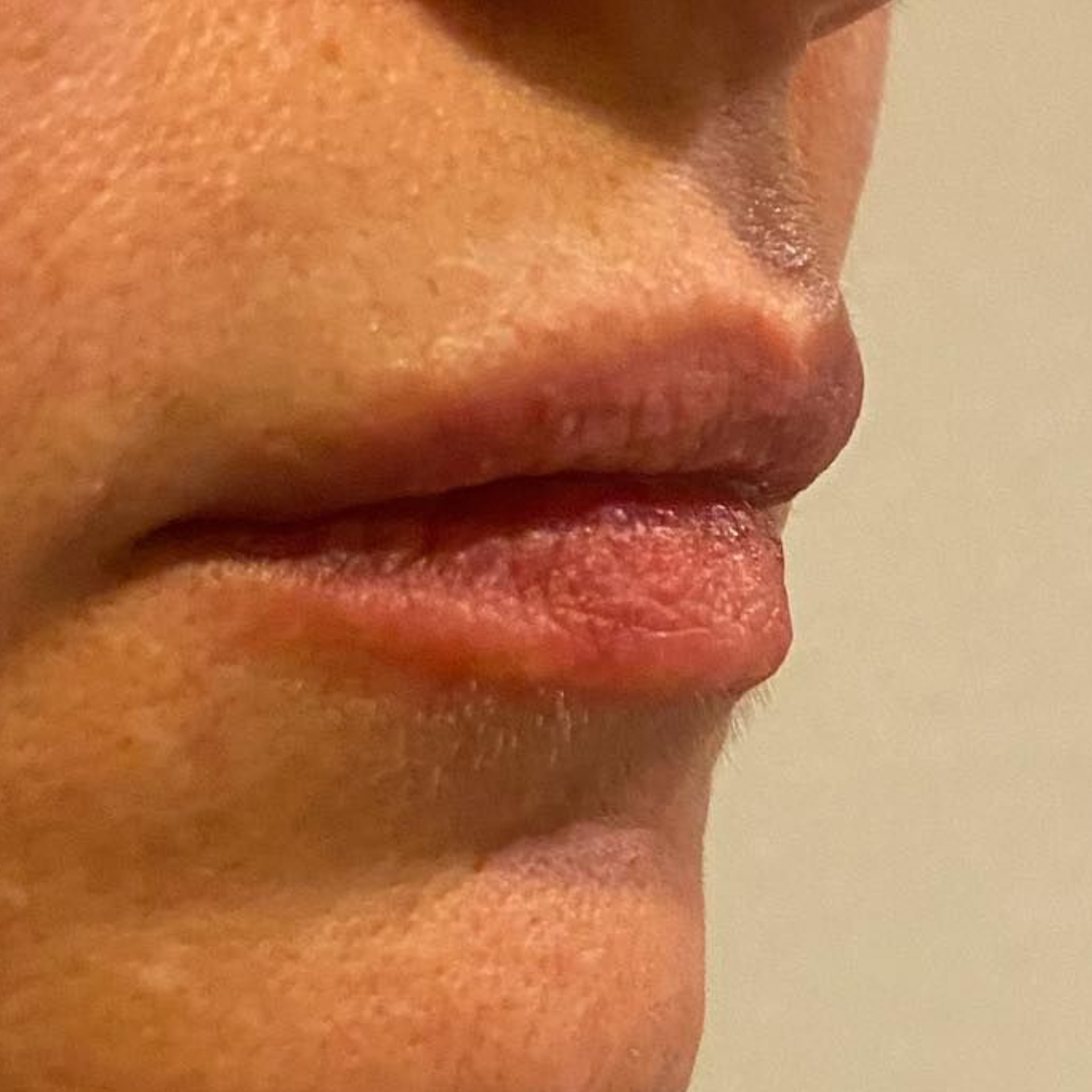 After HydraFacial Treatments
