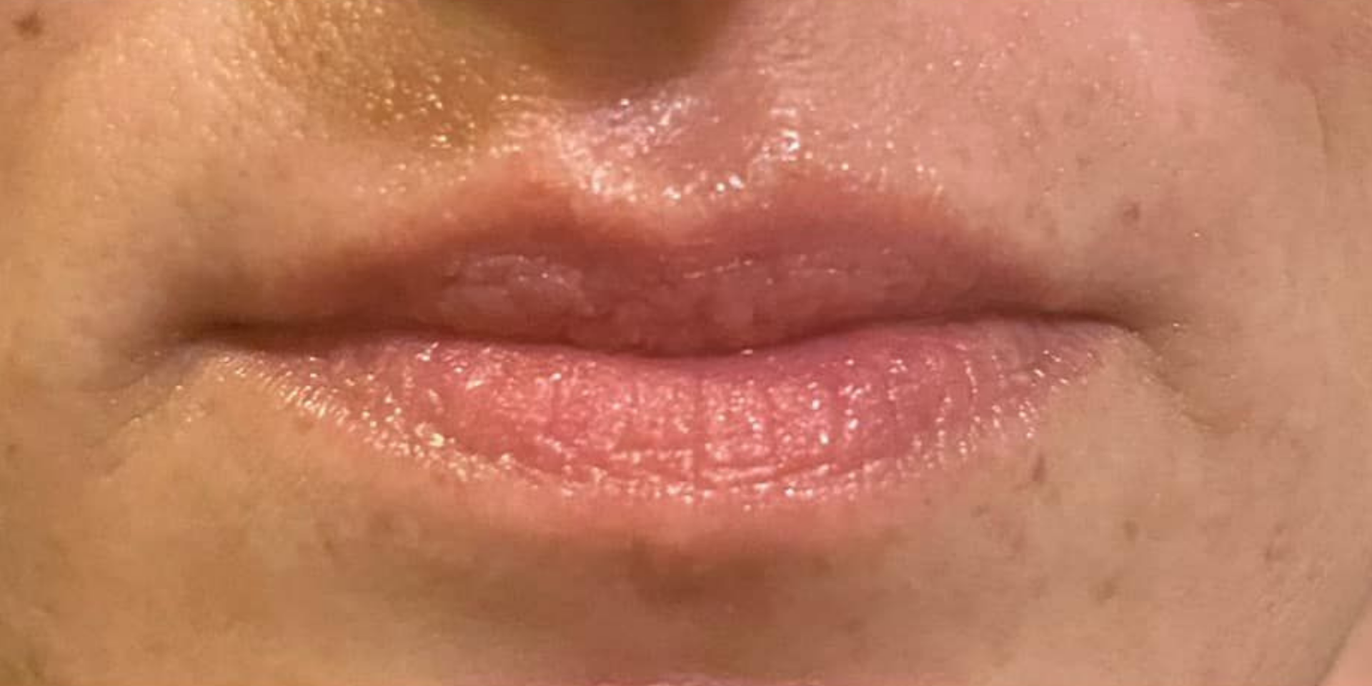 After HydraFacial Treatments