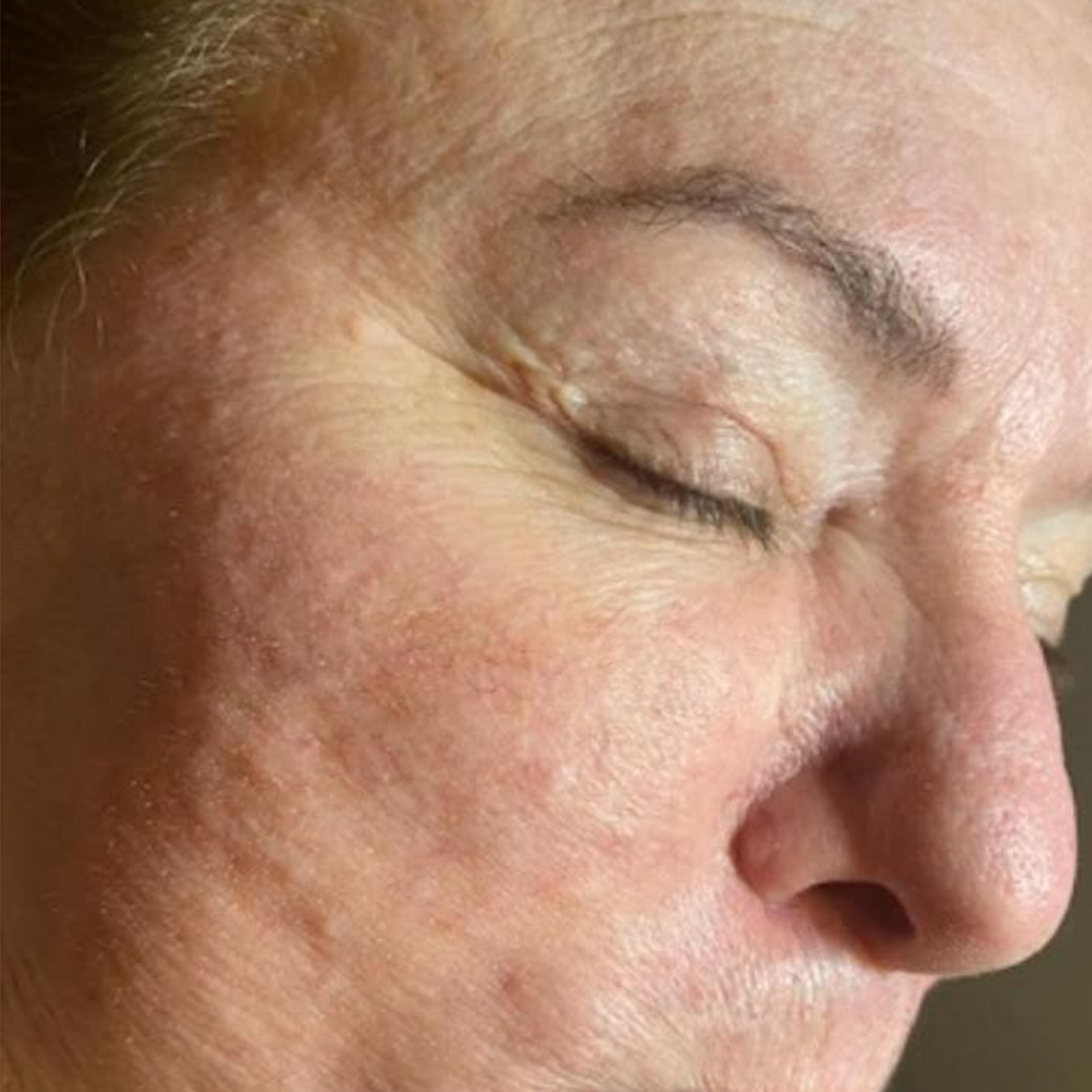 Before HydraFacial Treatments