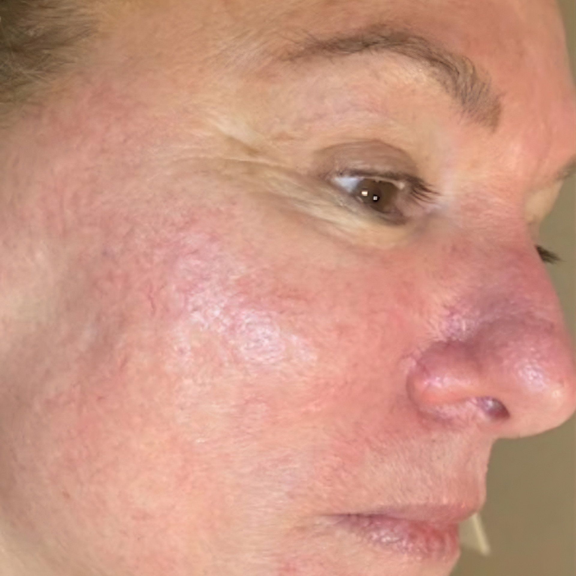 After HydraFacial Treatments