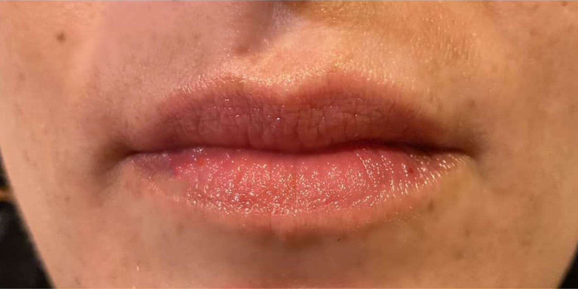 Before HydraFacial Treatments