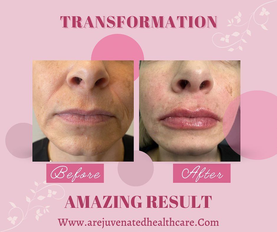 Before-and-after close-up of lips and lower face, showing transformation with “Before” and “After” labels.