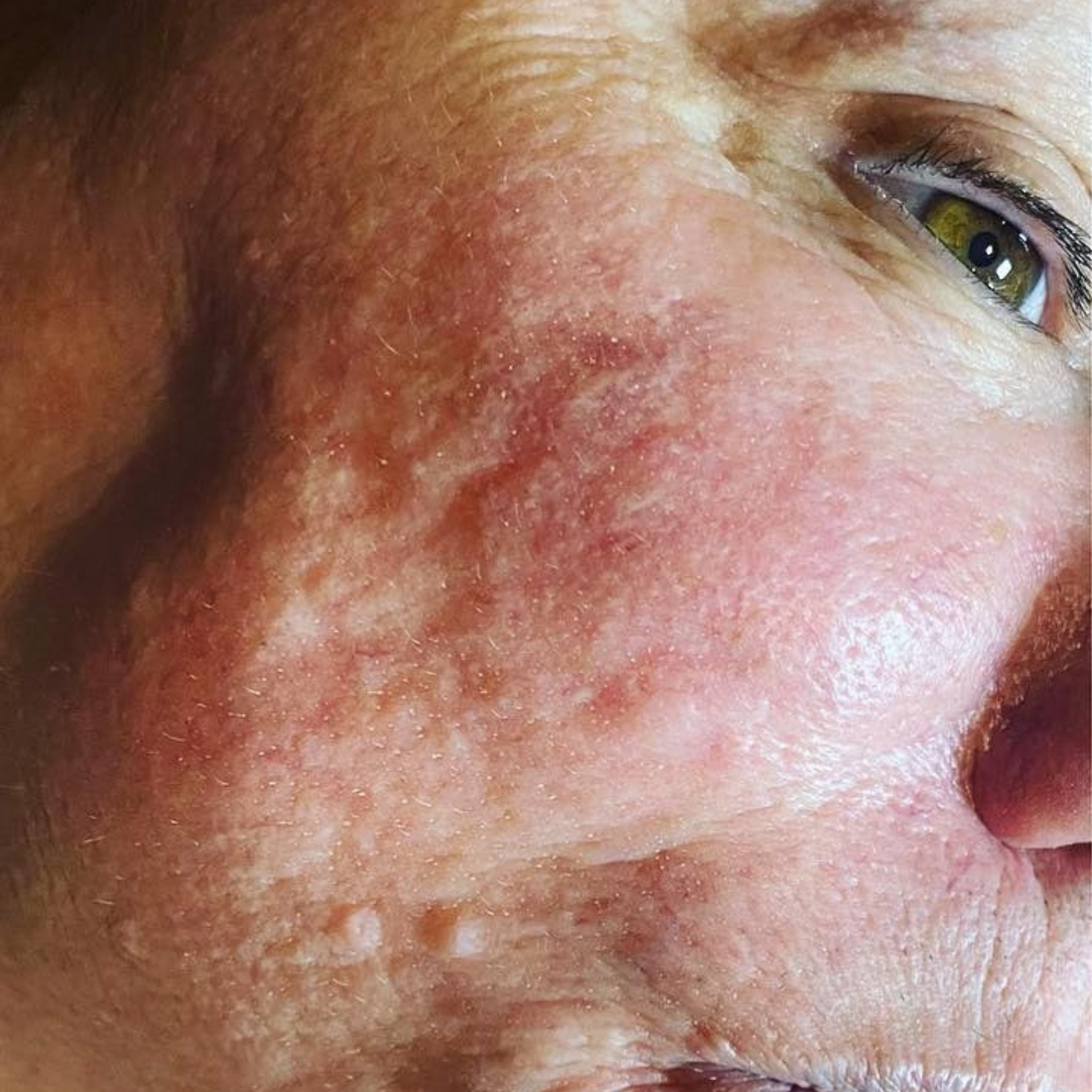 Before HydraFacial Treatments
