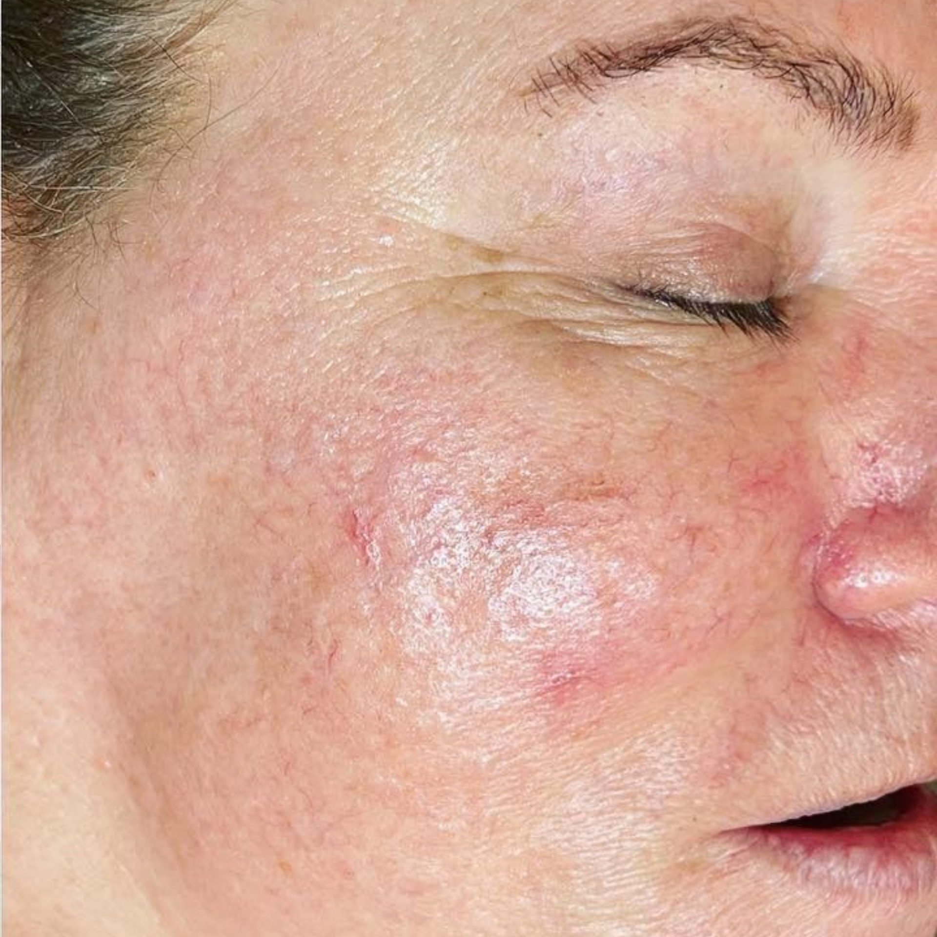 After HydraFacial Treatments