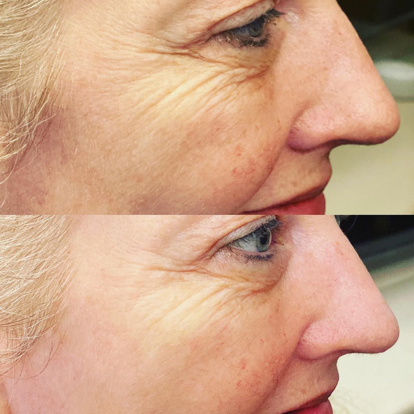 Side-by-side close-up profile of a woman's face, showing skin before and after treatment.