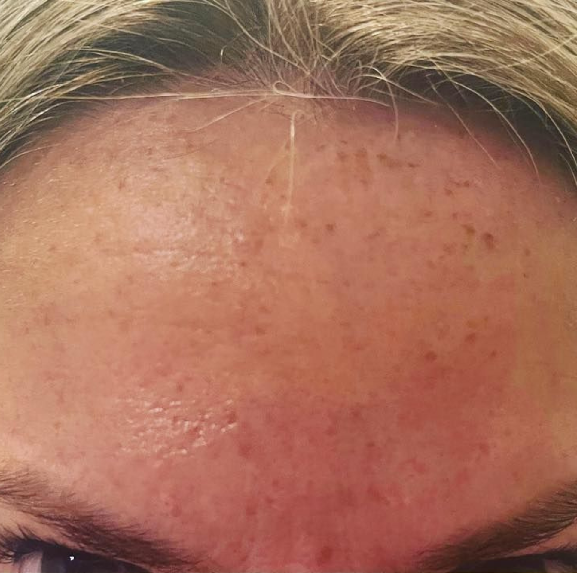 After IPL Skin Rejuvenation