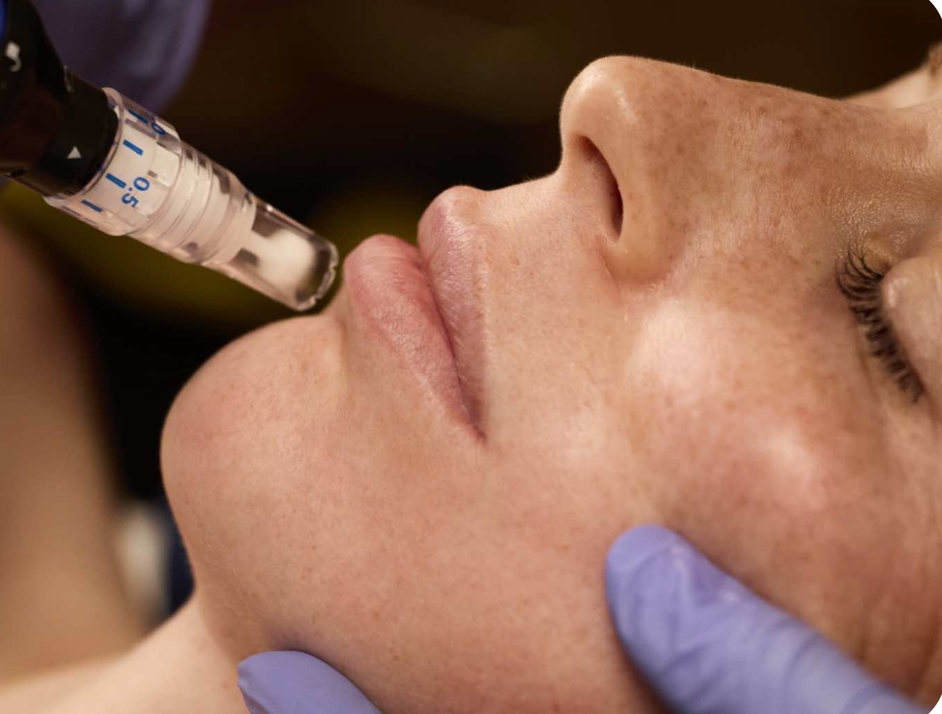 Person receiving cosmetic treatment, needle near cheek, pink-gloved hands, spa setting.