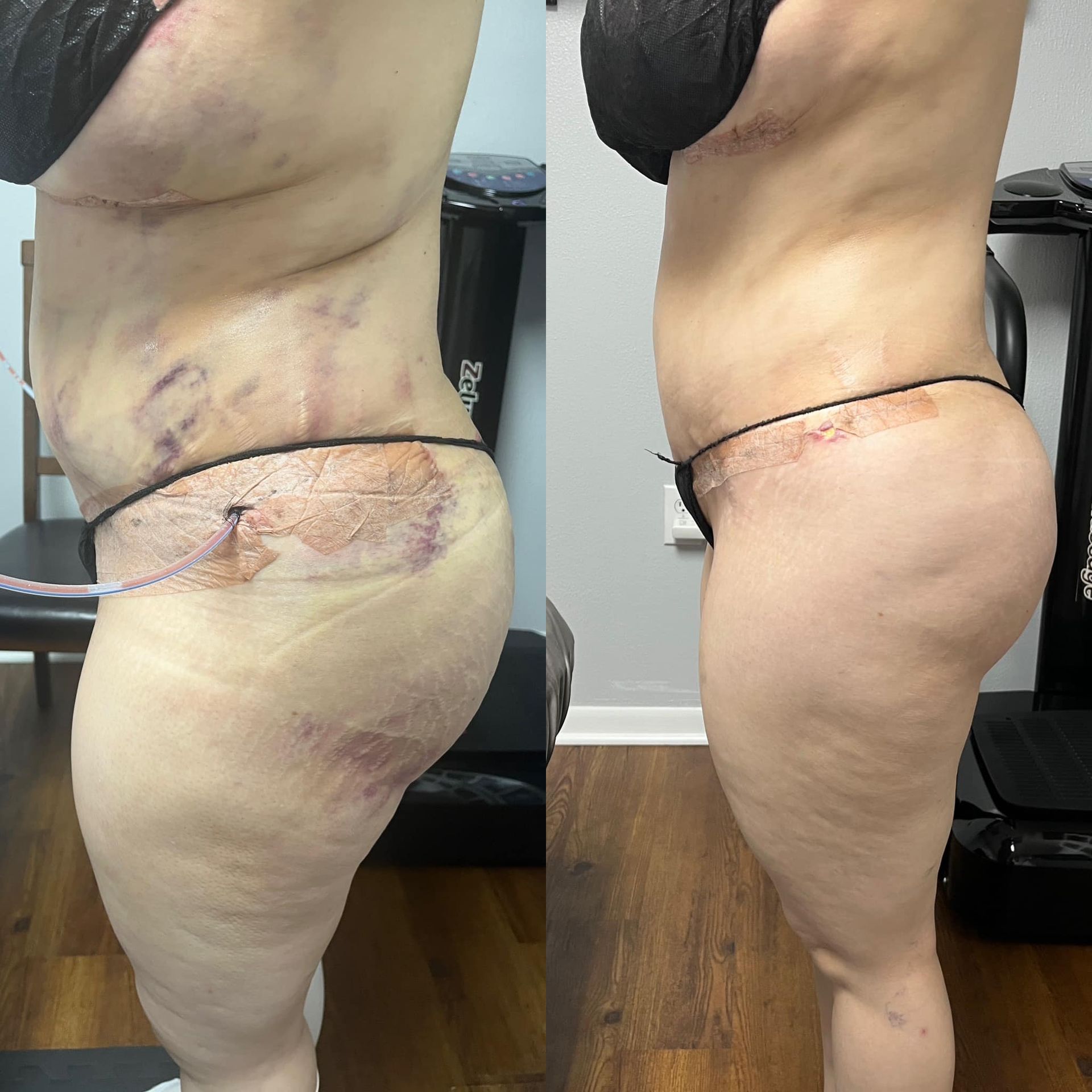 Two side-view photos of a person's torso and thighs