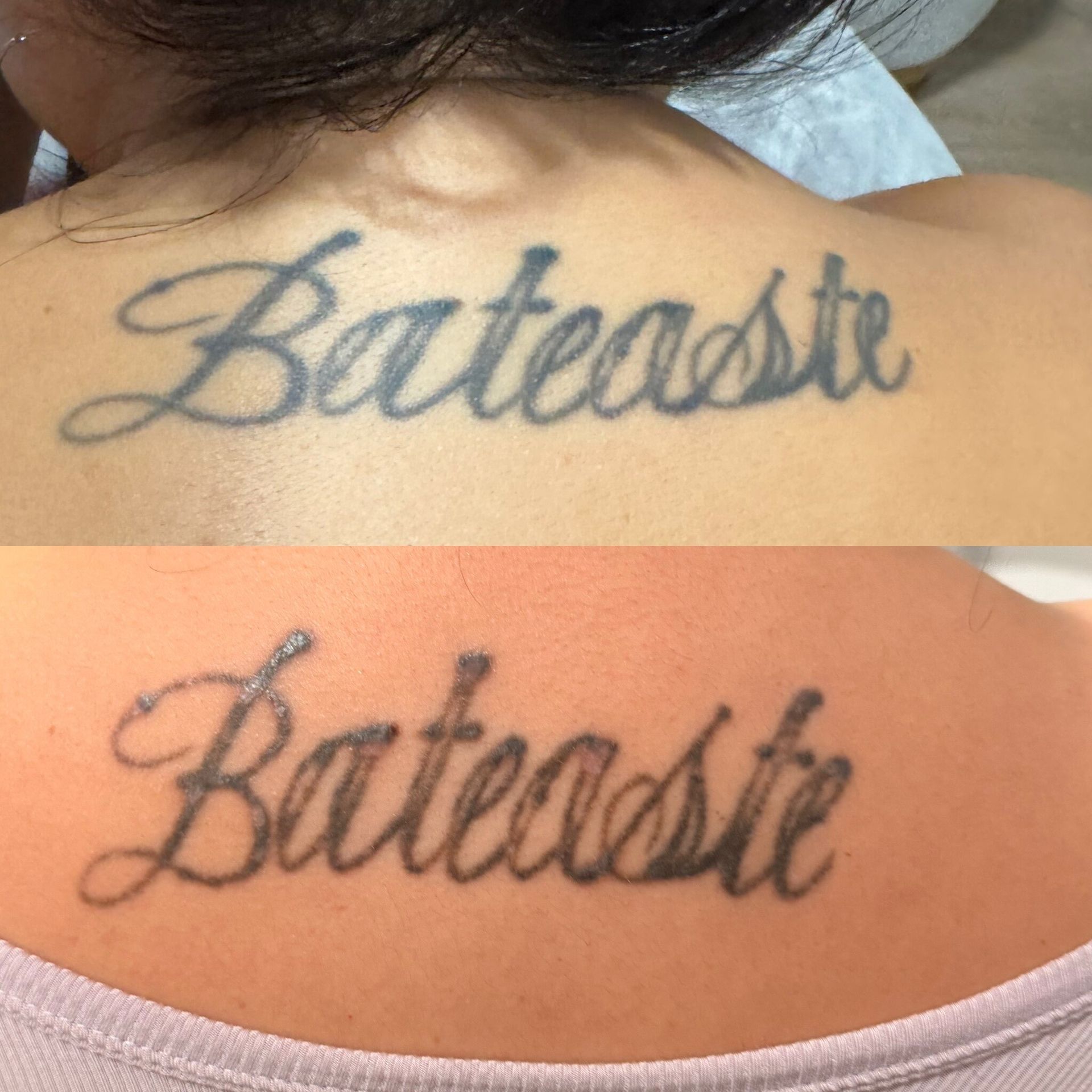 Comparison of a tattoo on a person's back, showing before and after laser removal treatment.