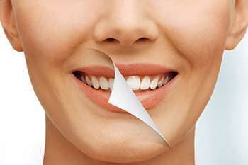 Before And After Teeth Whitening — Dental Care in  Burgettstown, PA
