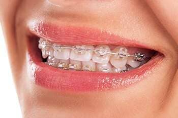 Braces — Dental Care in  Burgettstown, PA