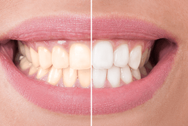 Teeth Whitening - whitening in Riverdale, MD