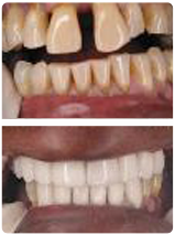 Smile Reconstruction Before and After-Smile Reconstruction, Teeth Whitening in Riverdale, MD