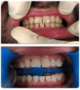 Teeth Whitening Before and After-Smile Reconstruction, Teeth Whitening in Riverdale, MD