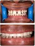 Before and After Crown Work-Cosmetic Dentistry, Crowns and Veneers in Riverdale, MD