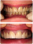 Before and After Crown Work-Cosmetic Dentistry, Crowns and Veneers in Riverdale, MD
