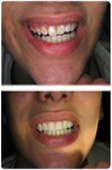 Before and After Veneer Work-Cosmetic Dentistry, Crowns and Veneers in Riverdale, MD