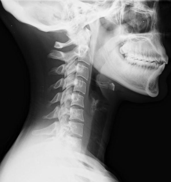 whiplash-neck-injury