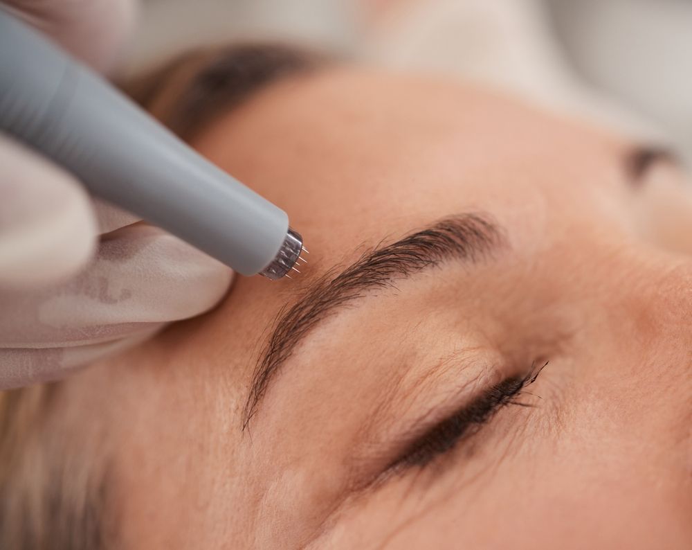 Close-up of a Person's Eyebrow Being Treated With a Microneedling Device — Artisan Cosmetic Tattoo & Beauty in Worongary, QLD