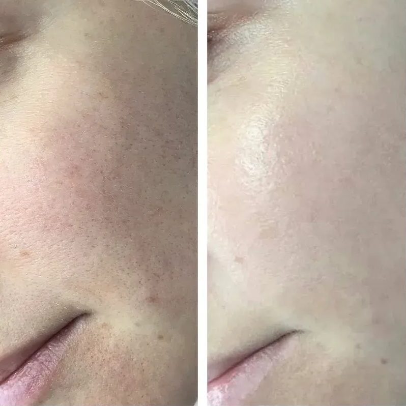 Side-by-side Comparison of Skin Texture — Artisan Cosmetic Tattoo & Beauty in Worongary, QLD