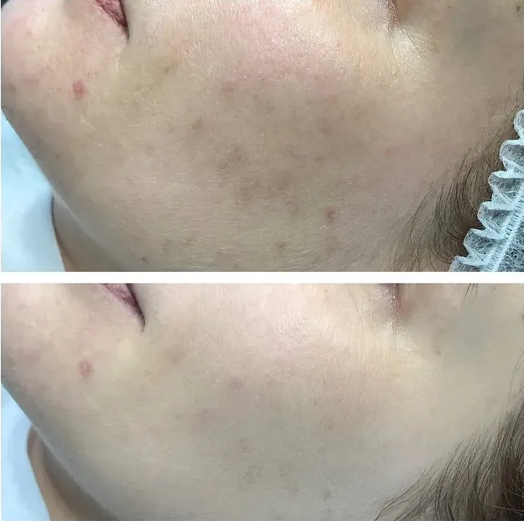 Before and After Comparison of Skin With Acne Spots — Artisan Cosmetic Tattoo & Beauty in Worongary, QLD