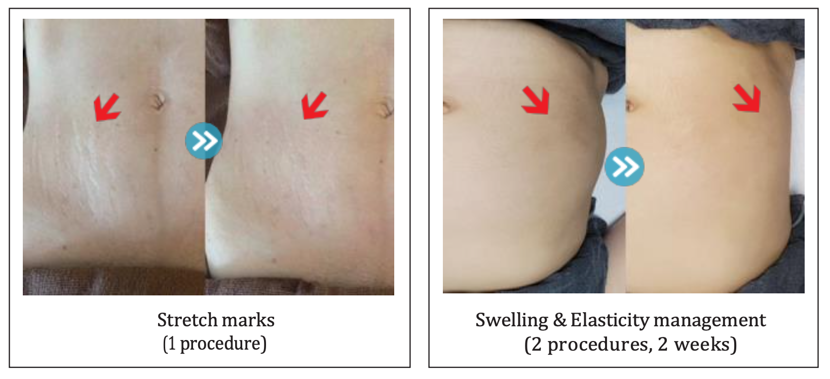 Ein Vorher-Nachher-Bild von Dehnungsstreifen auf dem Bauch einer Frau