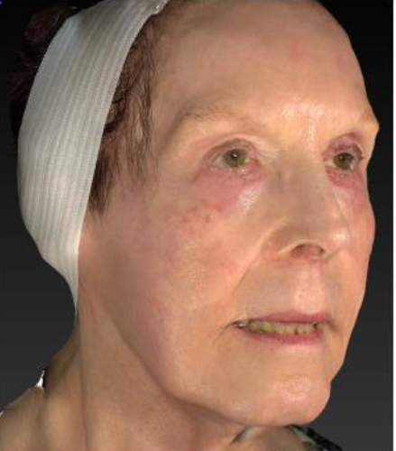 Eine Nahaufnahme des Gesichts einer älteren Frau mit einem Verband auf dem Kopf.