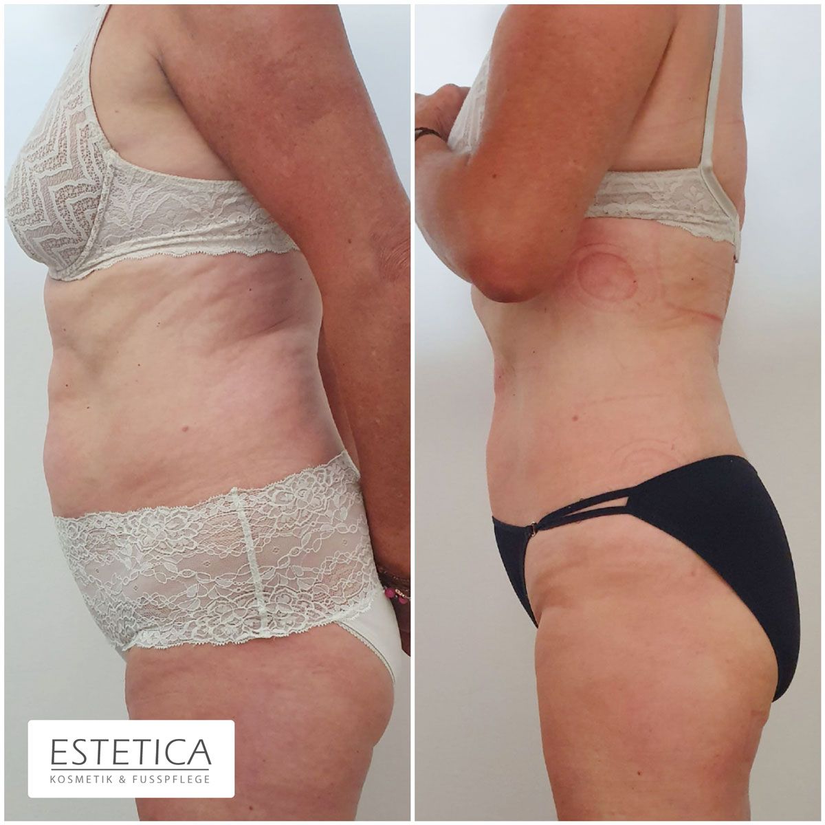 Ein Vorher-Nachher-Foto des Oberkörpers einer Frau mit der Aufschrift „Estetica“ auf der Unterseite
