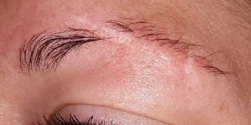 Eine Nahaufnahme der Augenbraue einer Frau mit Stichen darauf.