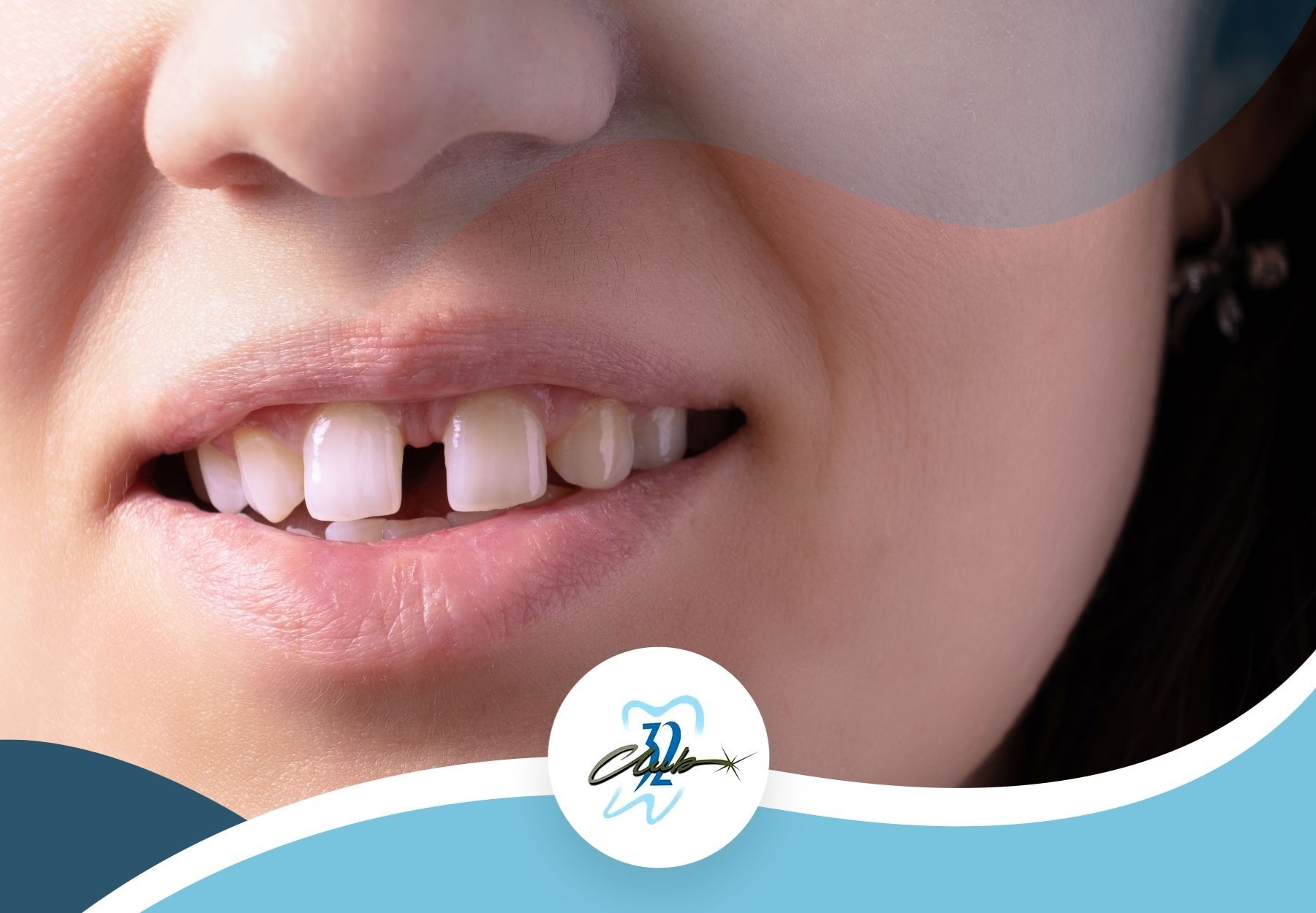 How Do You Fix Gaps Between Teeth? Club 32 Dentistry