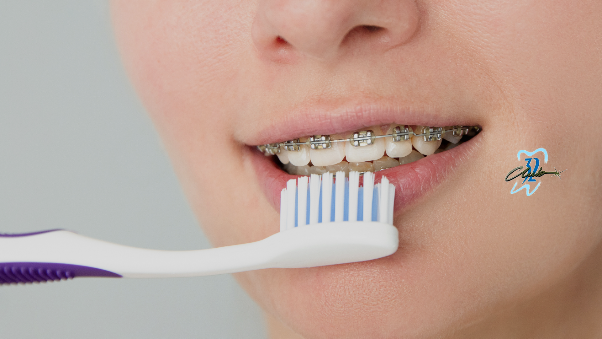 A woman with braces is brushing her teeth with a toothbrush.