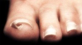 ipercheratosi, rieducazione delle unghie, podologa