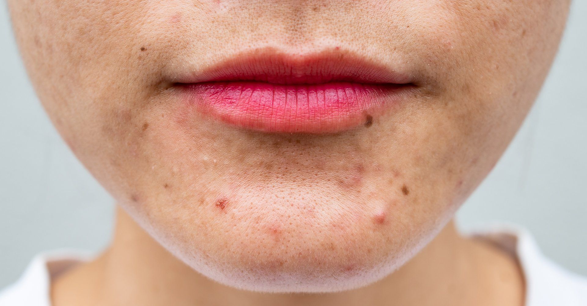 Face With Acne — Davenport, IA — William Colantoni Jr MD PC