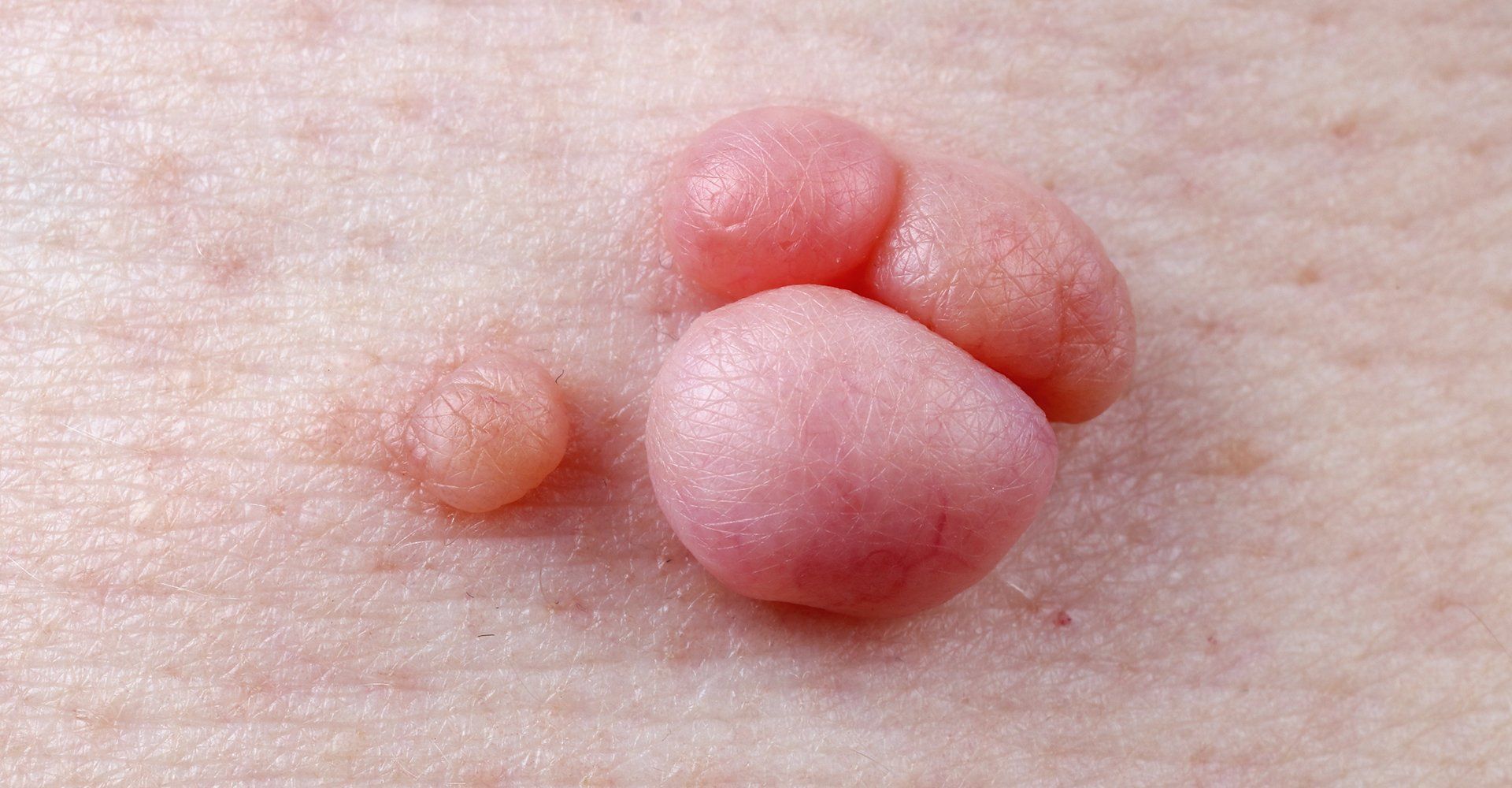 Polyps And Moles — Davenport, IA — William Colantoni Jr MD PC