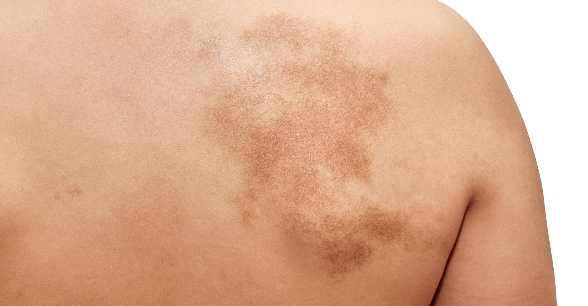 Close-up Of Birthmark — Davenport, IA — William Colantoni Jr MD PC