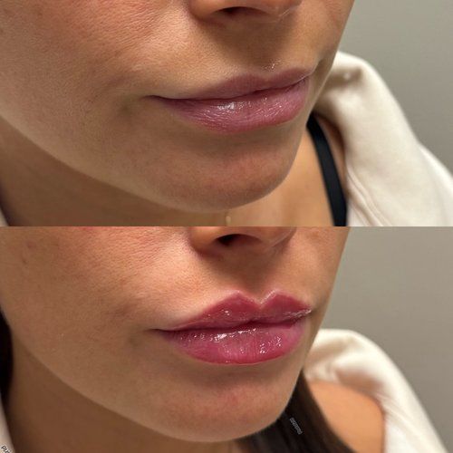 Before and after of a woman's lips. The bottom shows fuller, more enhanced lips with filler.
