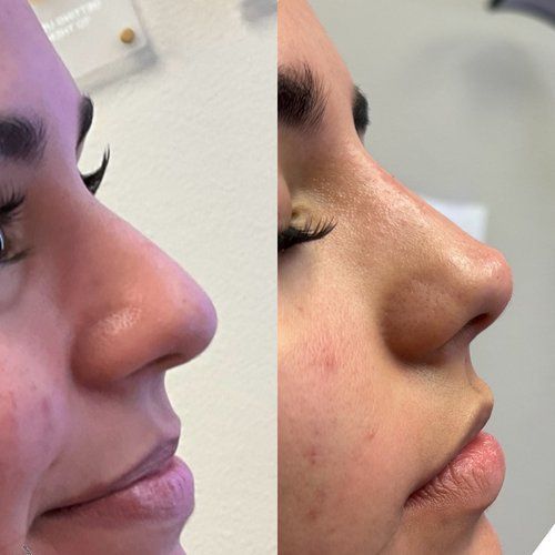 Before and after photos: woman's nose profile, showing a smoother, refined appearance after a procedure.