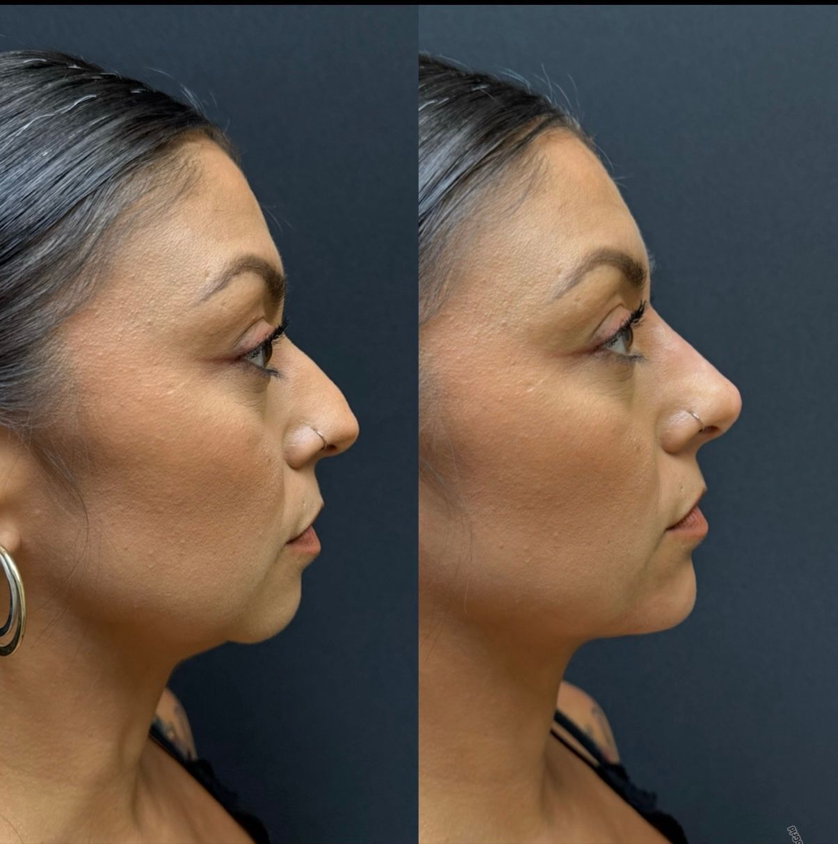 Side-by-side view: Before and after rhinoplasty. Profile view of a person with a nose change.