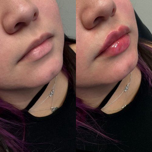 Before and after lip filler; woman with thin lips transforms to full, plump lips.