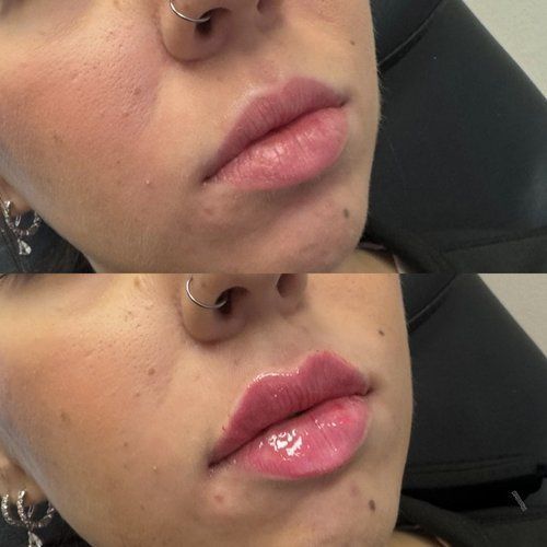Before and after photos of a woman with a nose ring and lip gloss. The lower image shows fuller lips.