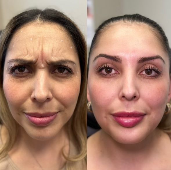 Before-and-after: Woman with forehead wrinkles frowns, then smooths with Botox, and full lips.